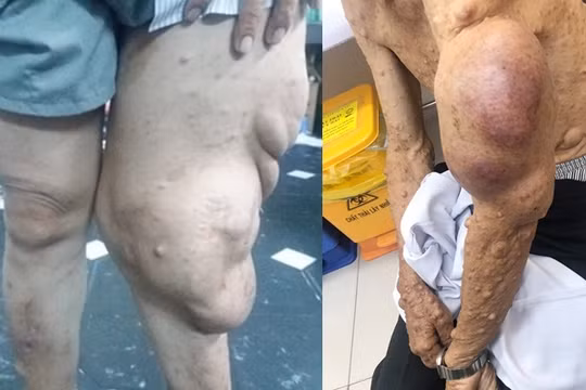 Cắt bỏ khối u sợi thần kinh khổng lồ khỏi cơ thể người đàn ông.