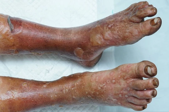 Hoại tử cả 2 chân vì ngâm bằng loại bột lá không xuất xứ