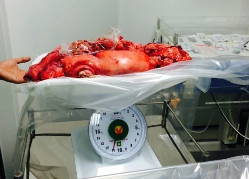 Khối u được cắt bỏ