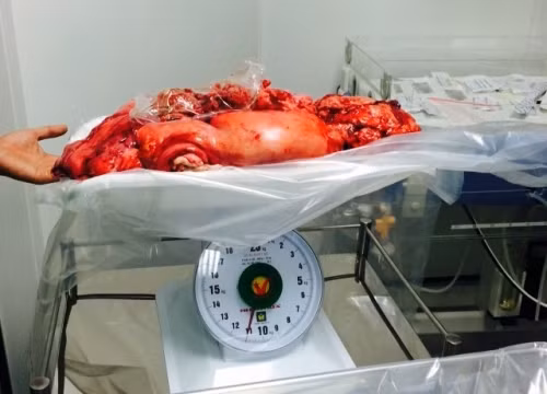 Khối u được cắt bỏ