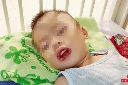 Bé trai không may bị uống nhầm thuốc tẩy bồn cầu, dẫn tới loét miệng và thực quản, dạ dày (Ảnh: BVCC) 