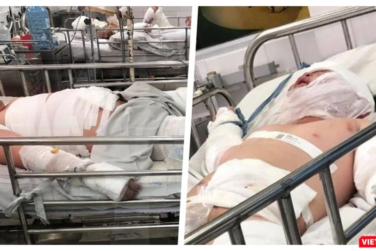 Thương tâm hai bệnh nhi bỏng nặng do cha ruột châm lửa đốt nhà (Ảnh: MT)