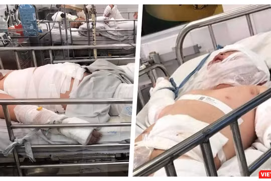 Thương tâm hai bệnh nhi bỏng nặng do cha ruột châm lửa đốt nhà (Ảnh: MT)