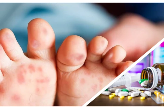 Có thông tin cho rằng thiếu thuốc điều trị bệnh tay chân miệng đang vào mùa cao điểm ở TP.HCM (Ảnh CarePlus, Hòa Bình ghép) 