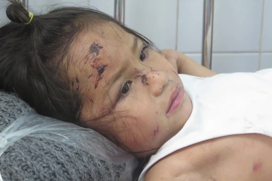 Bé Nguyễn Trần Sa Ny (5 tuổi) thoát chết trong vụ sạt lở núi nhưng trầy xước khắp người. Ảnh: Xuân Hiển