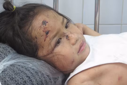 Bé Nguyễn Trần Sa Ny (5 tuổi) thoát chết trong vụ sạt lở núi nhưng trầy xước khắp người. Ảnh: Xuân Hiển