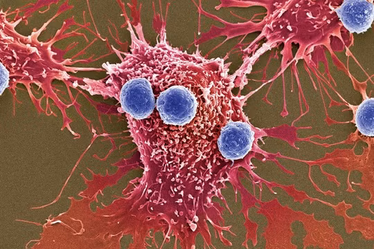 Liệu pháp mới được thông qua đột phá ở chỗ sử dụng các tế bào T đã chỉnh gen (xanh dương) để tấn công tế bào ung thư (màu đỏ) (Ảnh: Science Source)