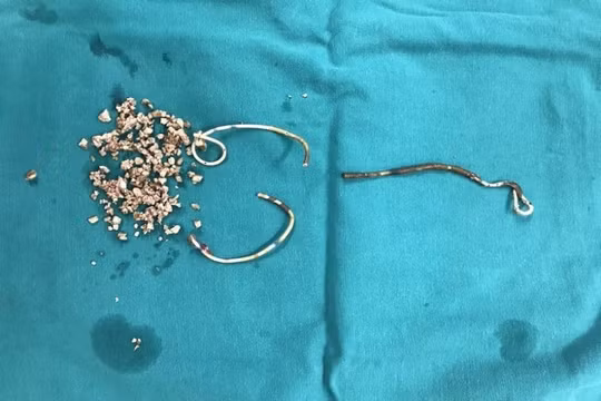 Đoạn stent jj gãy và sỏi lấy ra khỏi cơ thể bệnh nhân