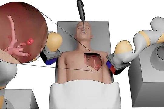 Robot mềm xúc tu từ tính phẫu thuật khối u phổi ngoại biên vùng não trước. Ảnh Đại học Leeds.