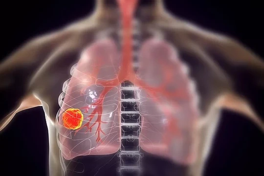 Mô phỏng đồ họa bệnh ung thư phổi. Ảnh minh họa Euronews. Next.