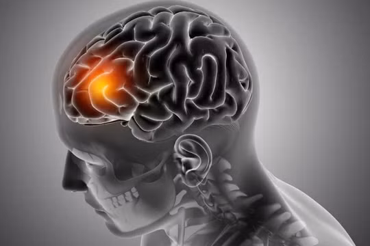 Các nhà khoa học cho thấy một khả năng mới điều trị u nguyên bào thần kinh đệm. Ảnh Euro News. Next