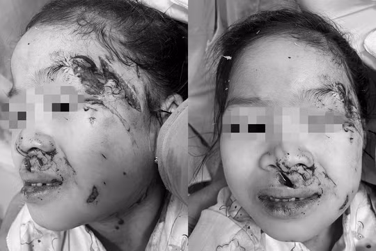 Bệnh nhi Nguyễn Ánh L. bị chó cắn tổn thương nặng vùng đầu và mặt