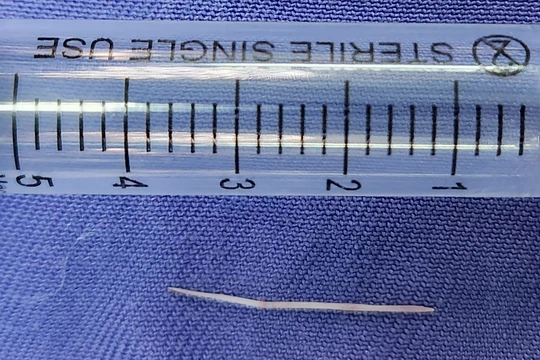Chiếc xương cá dài 2,5cm được lấy từ sàn miệng bệnh nhân