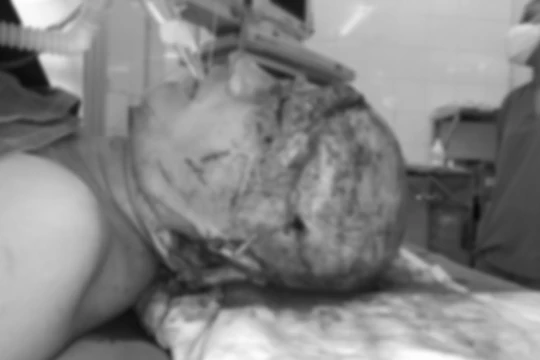 Bệnh nhân bị lột toàn bộ da đầu, 2 tai, mí mắt