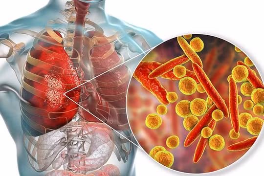 Virus Mycoplasma pneumoniae gây viêm phổi ở trẻ (ảnh BVCC)