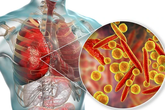 Virus Mycoplasma pneumoniae gây viêm phổi ở trẻ (ảnh BVCC)