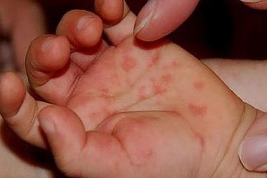 Biểu hiện của trẻ mắc tay chân miệng