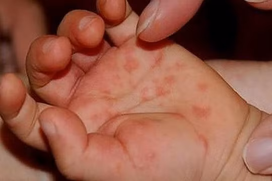 Biểu hiện của trẻ mắc tay chân miệng