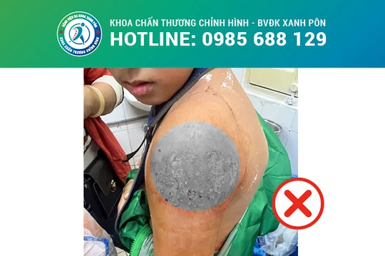 Bệnh viện đa khoa Xanh Pôn (Hà Nội) cảnh báo nguy hiểm tính mạng đối với người bệnh khi điều trị gãy xương bằng bó lá.