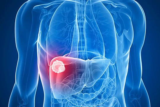 Ở Việt Nam, tử vong do ung thư gan gấp 3,8 lần tử vong do tai nạn giao thông (ảnh BVCC)