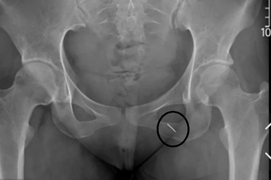 Phim X-quang thể hiện cây kim may đâm và chui sâu vào cơ thể bệnh nhân