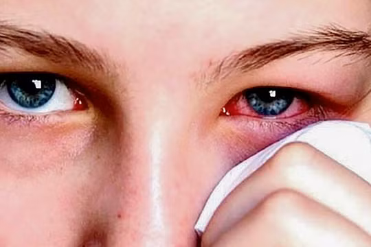 Bệnh nhân đau mắt đỏ