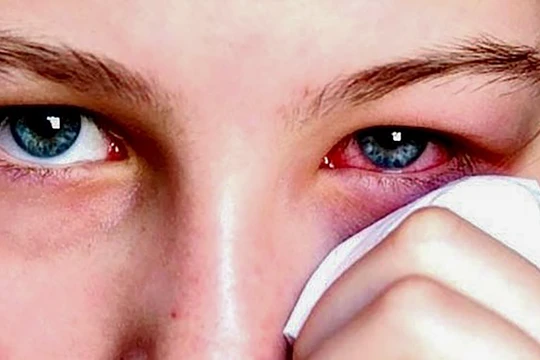 Bệnh nhân đau mắt đỏ