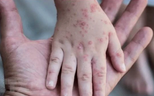 Bệnh đậu mùa khỉ thường có các triệu chứng như sốt, đau đầu, đau cơ, đau lưng, sưng hạch bạch huyết, ớn lạnh, mệt mỏi, phát ban có thể nhìn giống như mụn nước. Ảnh: Internet.