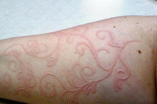 Bệnh lý da vẽ nổi rất hay gặp ở trẻ em, đặc biệt trong mùa mưa (ảnh minh họa)