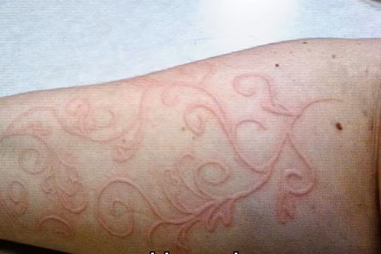 Bệnh lý da vẽ nổi rất hay gặp ở trẻ em, đặc biệt trong mùa mưa (ảnh minh họa)