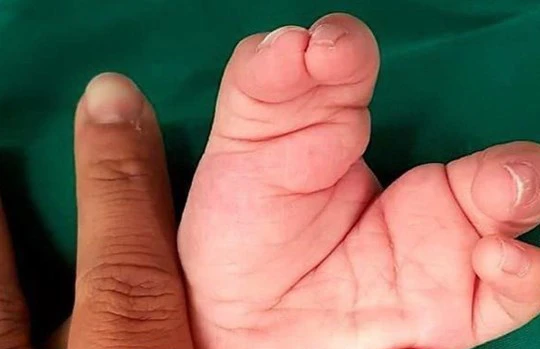 Bé trai hai tuổi vừa được các bác sĩ BV Nhi Đồng cứu thoát khỏi chứng tay chân càng cua 