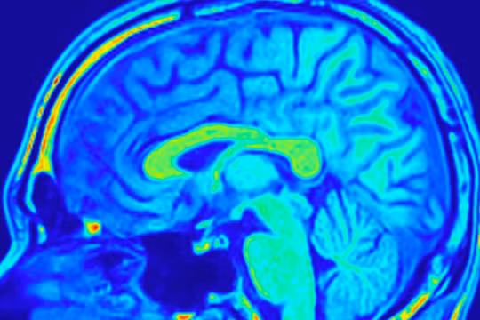 Hình chụp công hưởng từ não. Ảnh: FocalFinder/Shutterstock