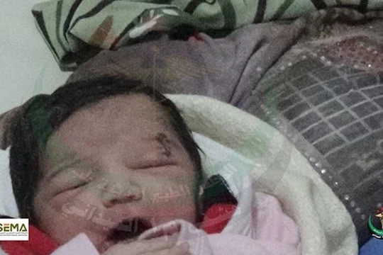 Bé Amel bị một vết thương dài bên mắt trái - Ảnh: Facebook
