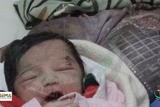 Bé Amel bị một vết thương dài bên mắt trái - Ảnh: Facebook