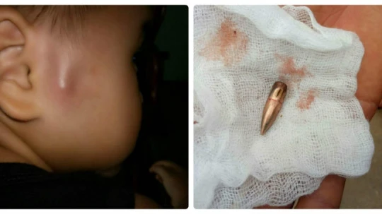 Cháu bé ở trường mầm non Họa Mi - thị trấn Gia Khánh - bị đạn bắn trúng. Ảnh: VTV 