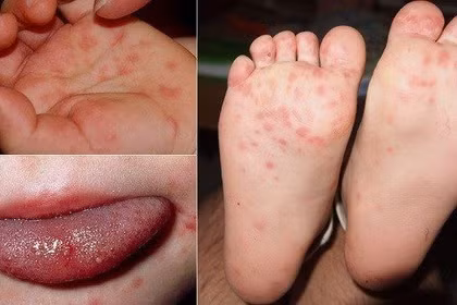 Bệnh tay chân miệng đang gia tăng nhanh. Ảnh minh họa