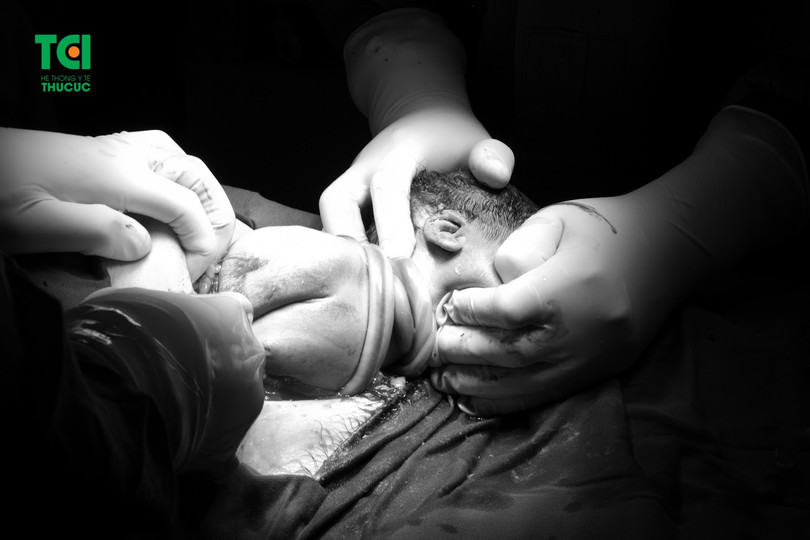 Em bé chào đời với cân nặng gần 4kg và 3 vòng dây rốn quấn cổ. (Nguồn: TCI)