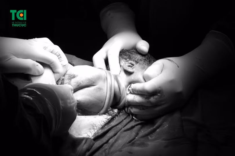 Em bé chào đời với cân nặng gần 4kg và 3 vòng dây rốn quấn cổ. (Nguồn: TCI)