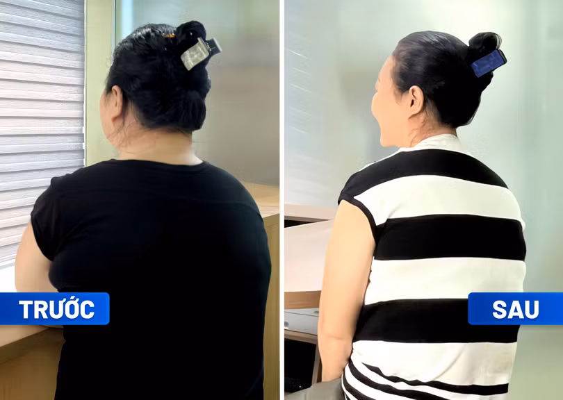 Sau 3 tháng điều trị tại Trung tâm Giảm cân Tâm Anh, bà Chea (56 tuổi, quốc tịch Campuchia) giảm được 10kg, đi lại nhẹ dễ dàng hơn, giảm cảm giác thở dốc khi vận động, thoát khỏi nguy cơ phẫu thuật thay k.jpg