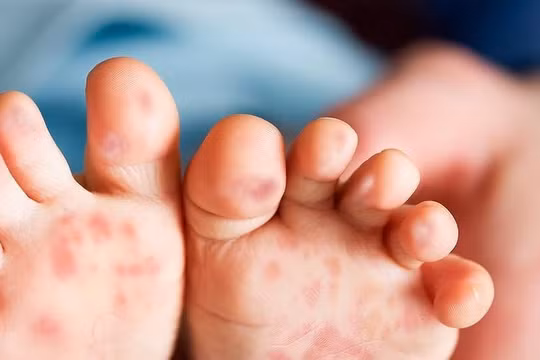 Trẻ mắc tay chân miệng tăng nhanh, nhiều ca diễn tiến nặng 