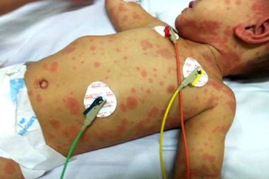 Não mô cầu gia tăng, nguy hiểm khi dễ nhầm với cúm, tỷ lệ tử vong cao