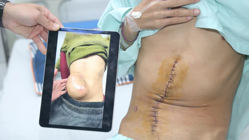 So sánh khối u lúc bệnh nhân đến BV và vết mổ sau khi cắt khối u