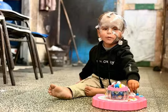 Cậu bé Mohammed Abu Hajeela 2 tuổi đeo mặt nạ ép khí sau khi bị bỏng nặng cấp độ ba trong một cuộc tấn công của Israel vào hầm trú ẩn của trường học ở thành phố Gaza vào tháng 7/2025. Ảnh: AJ.