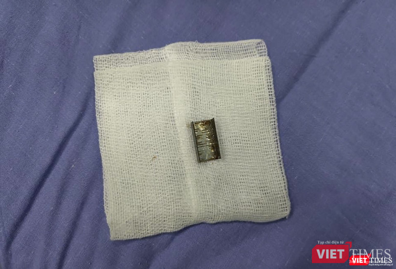 Dị vật mảnh kim loại được nội soi lấy ra từ bệnh nhân nhi nhập viện cấp cứu