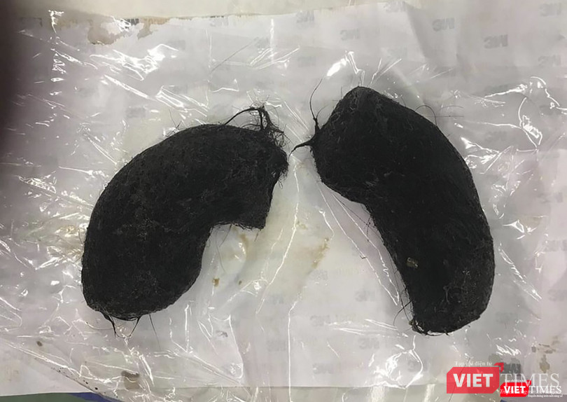 Búi tóc được lấy ra từ dạ dày của bệnh nhi 13 tuổi nhập viện trong tình trạng nguy kịch