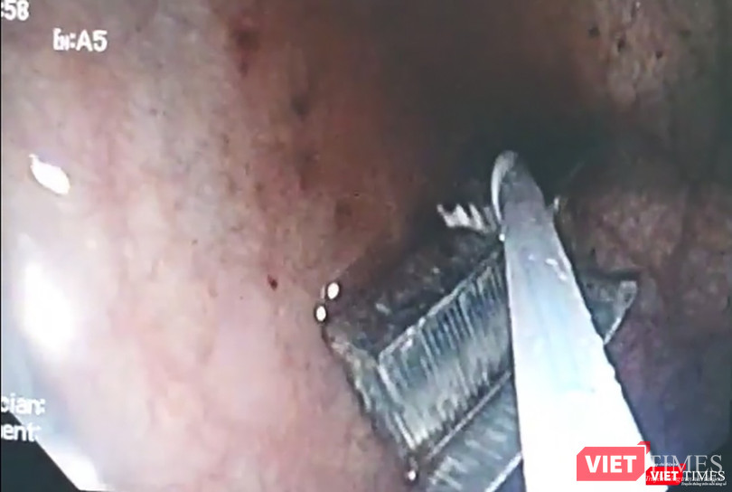 Camera nội soi ghi lại hình ảnh gắp dị vật là vĩ ghim bấm bên trong đường thở của trẻ