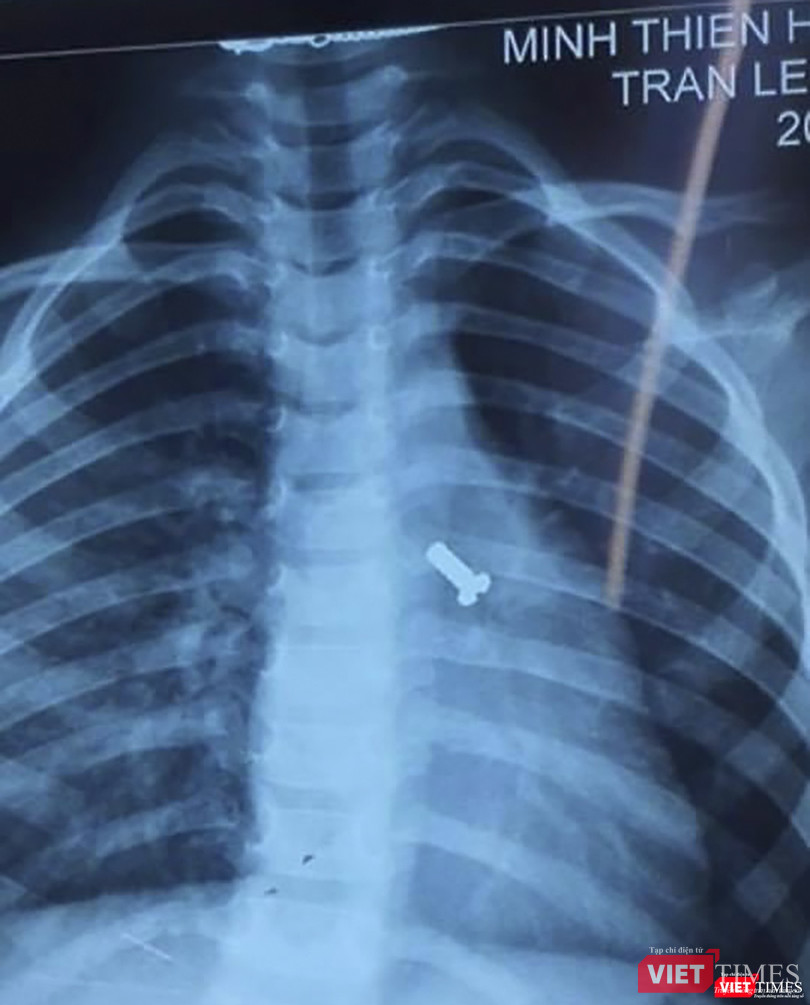 Phim X-quang đinh vít nằm ở đường thở của trẻ