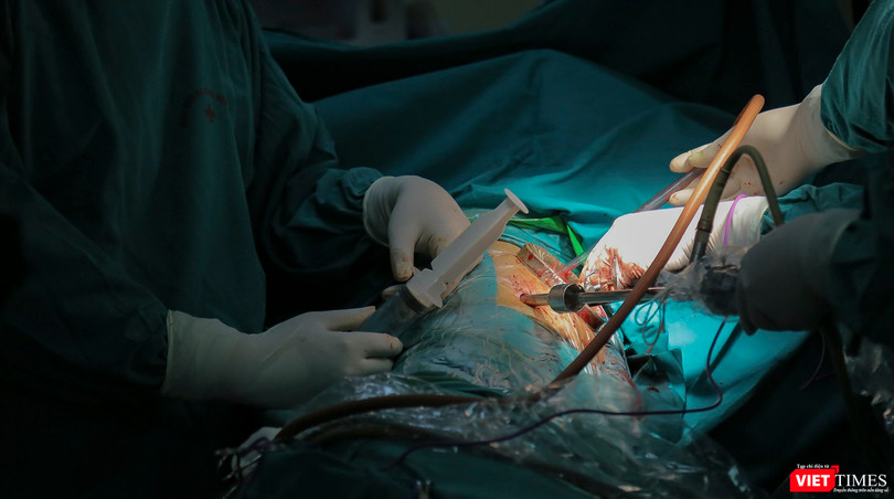 Ê-kíp bác sĩ phẫu thuật do Ths.Bs Nguyễn Văn Lâm – Khoa Ngoại tổng hợp, Bệnh viện đa khoa Đức Giang sử dụng kỹ thuật nội soi để bóc ổ cặn màng phổi nghi do di chứng COVID-19 cho bệnh nhân