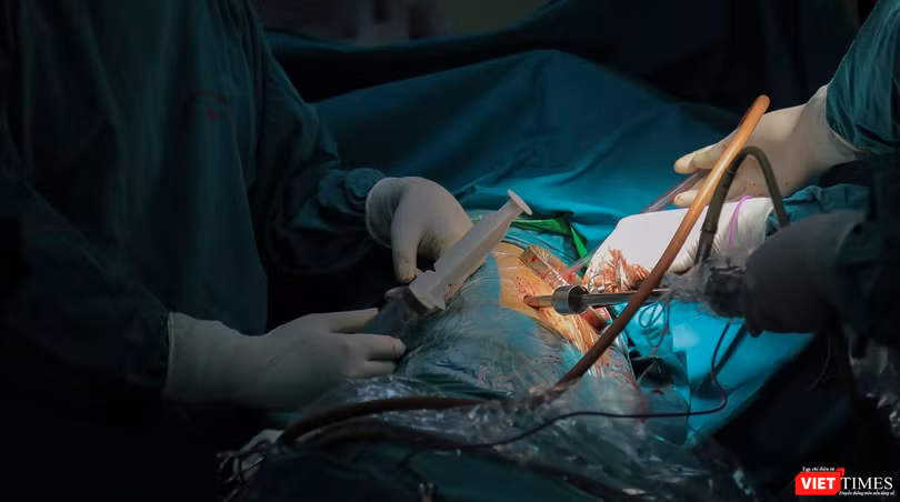 Ê-kíp bác sĩ phẫu thuật do Ths.Bs Nguyễn Văn Lâm – Khoa Ngoại tổng hợp, Bệnh viện đa khoa Đức Giang sử dụng kỹ thuật nội soi để bóc ổ cặn màng phổi nghi do di chứng COVID-19 cho bệnh nhân