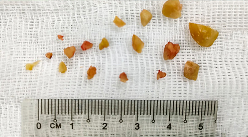 Hình ảnh hạt lạc mắc trong phế quản và được gắp ra ngoài sau khi phá thành nhiều mảnh nhỏ (ảnh BVCC)